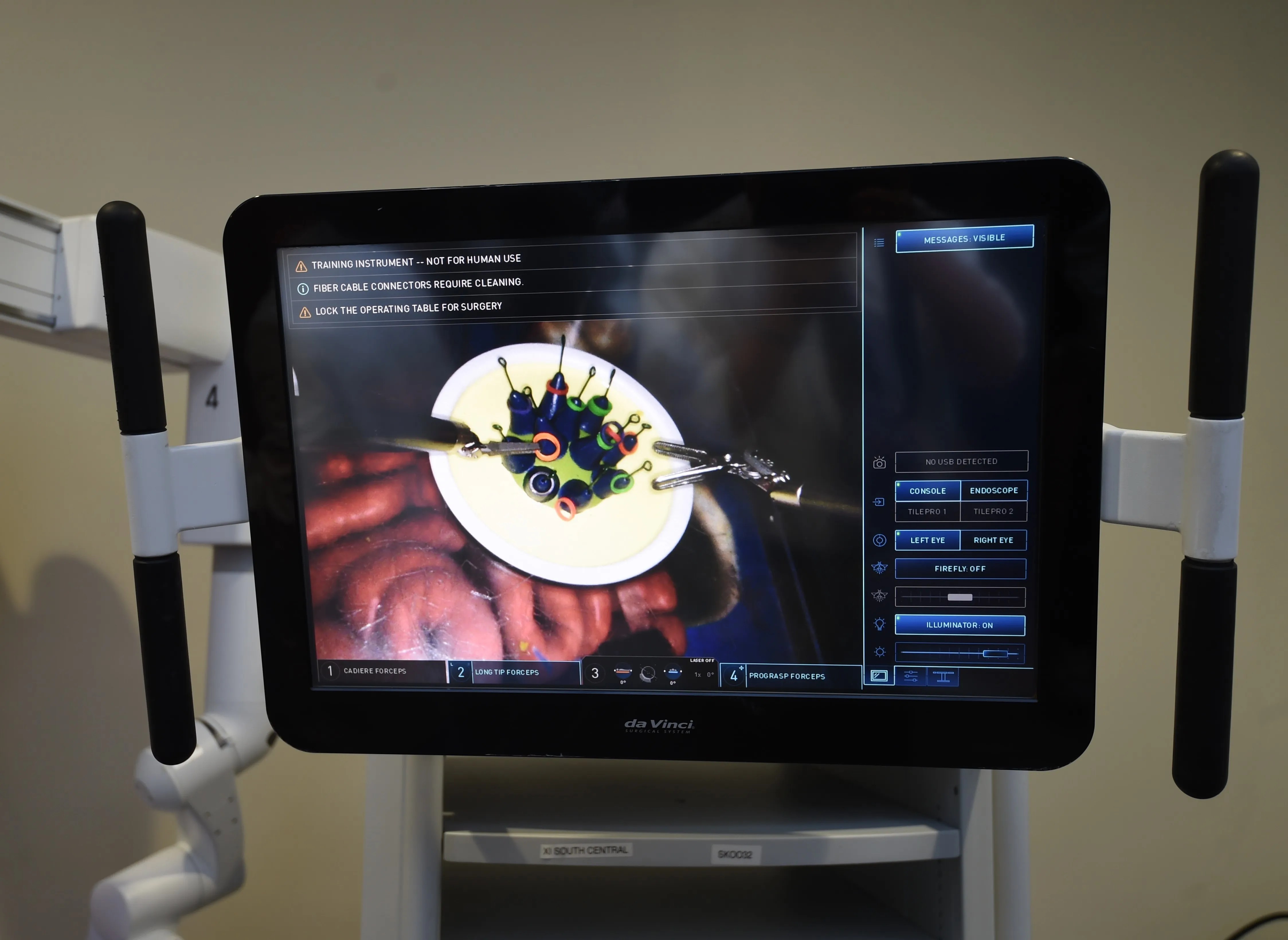 This overhead display shows the view from the camera in the da Vinci Xi surgical system. The robot has four arms and allows surgeons to conduct minimally invasive surgeries.