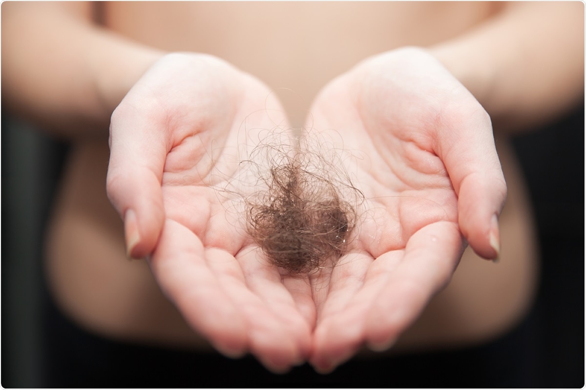 Recovered COVID-19 patients report hair loss months after infection