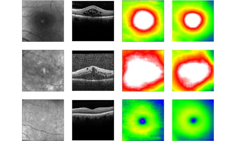 Novel deep learning method enables clinic-ready automated screening for diabetes-related eye disease
